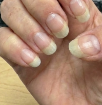 Stopped the peeling