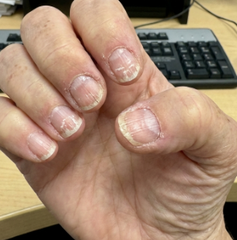 Stopped the peeling