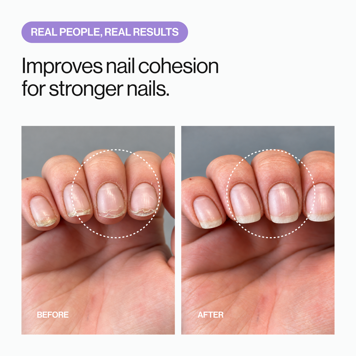 Before and after nail care for peeling nails